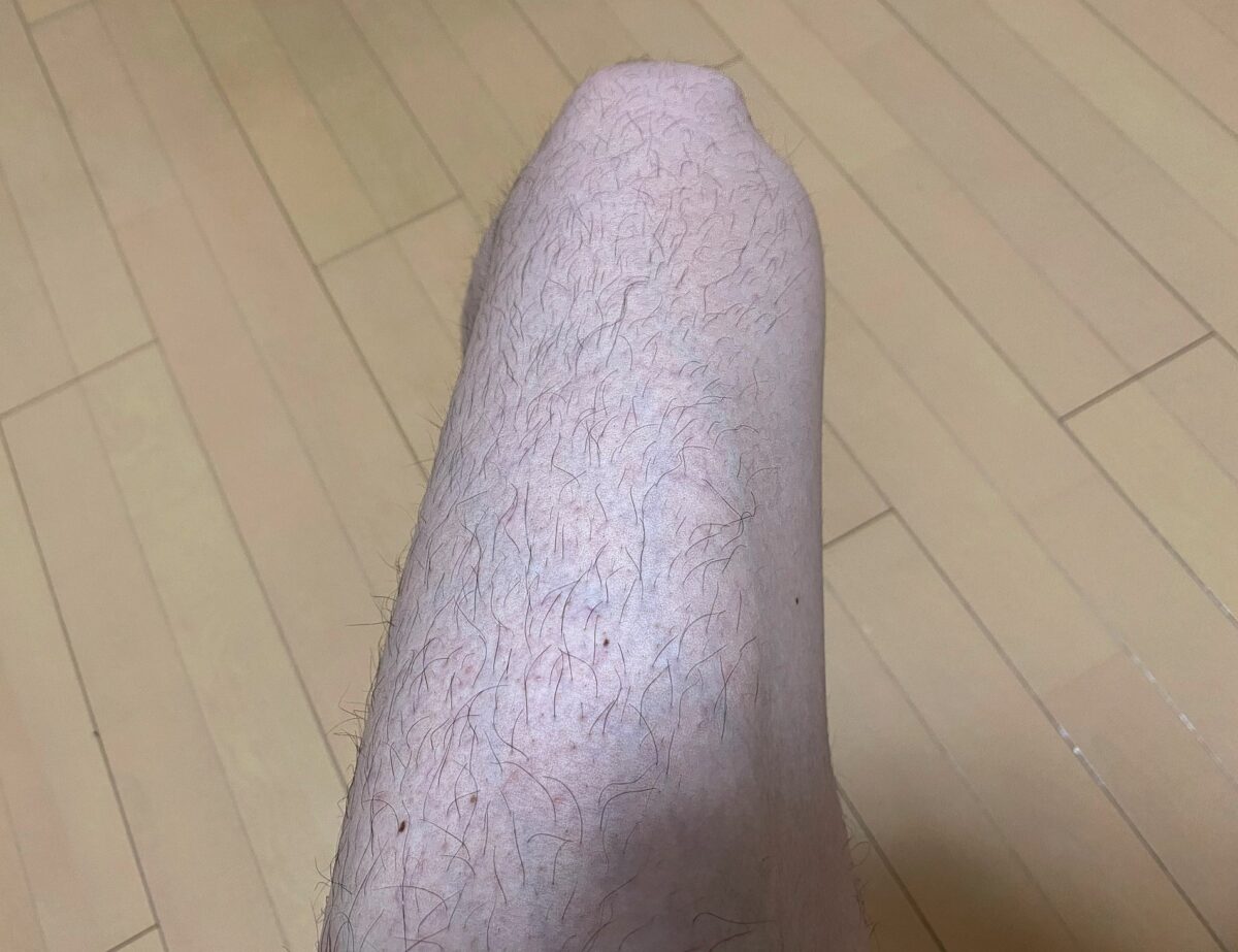 男の全身脱毛1回目の効果