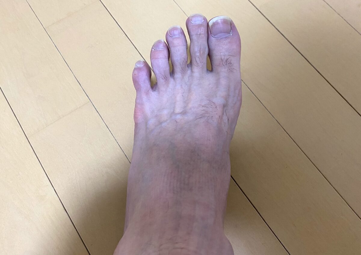 男の全身脱毛1回目の効果