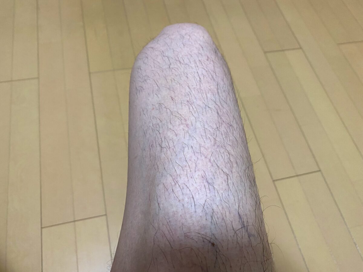男の全身脱毛1回目の効果
