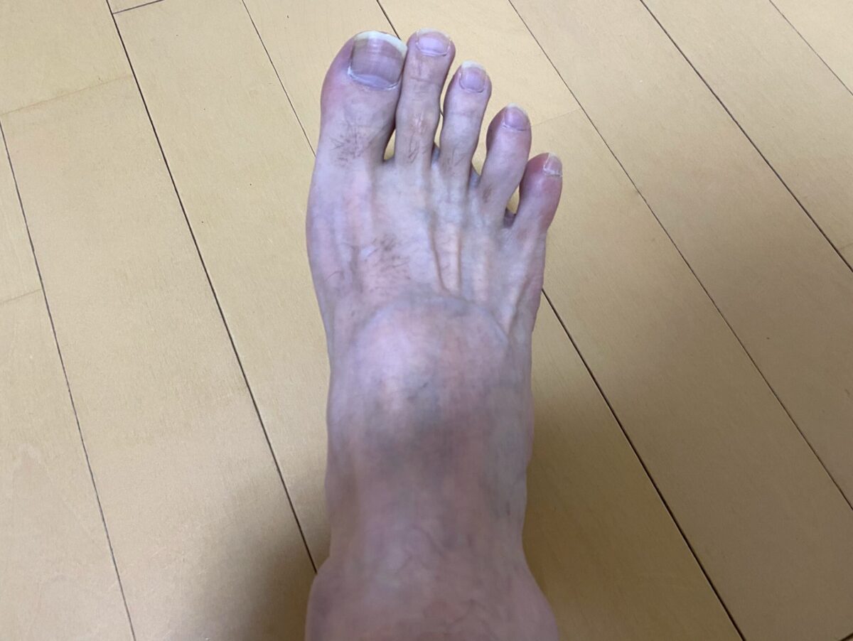 男の全身脱毛1回目の効果