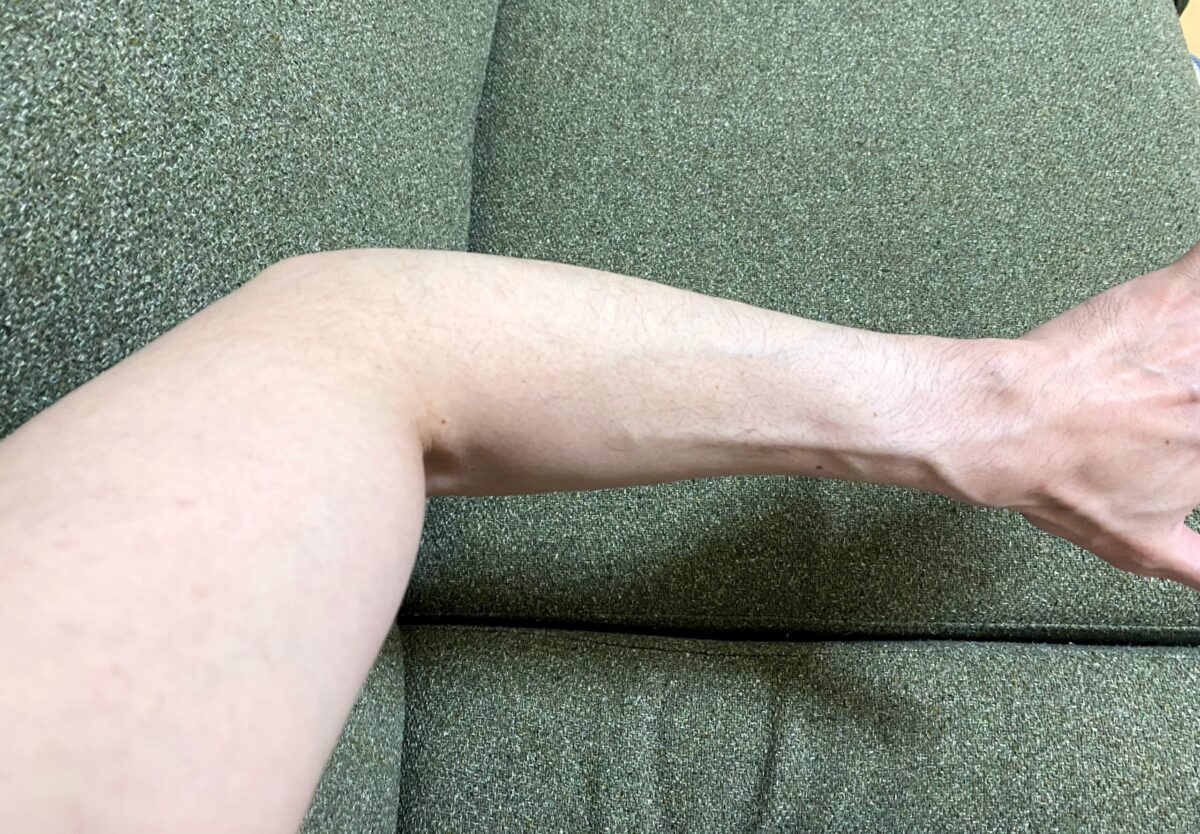 男の全身脱毛1回目の効果