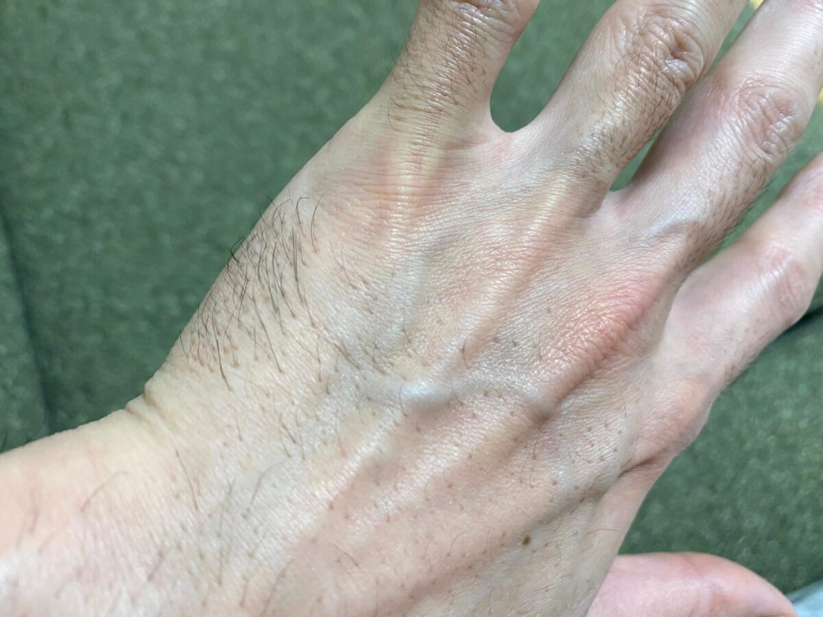 男の全身脱毛1回目の効果