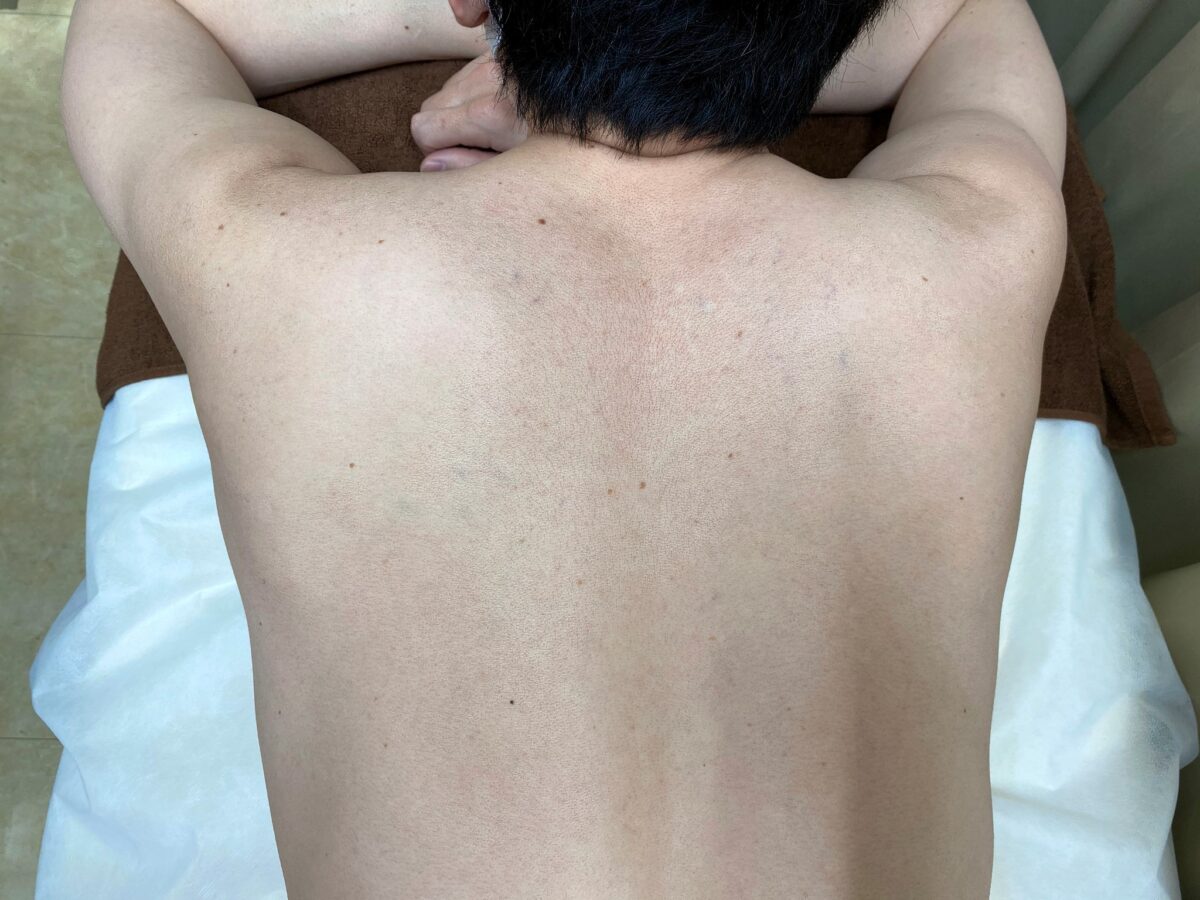 男の背中脱毛の施術前