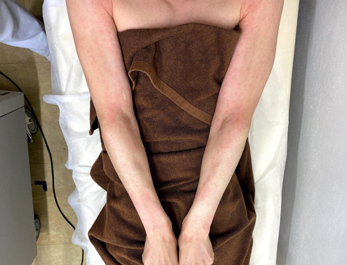 男の腕脱毛1回目の模様