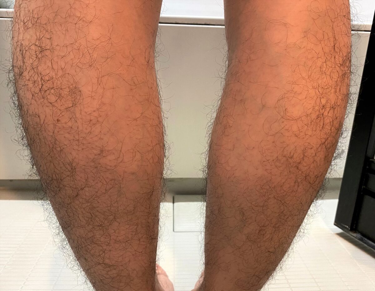 男の全身脱毛前のすね裏