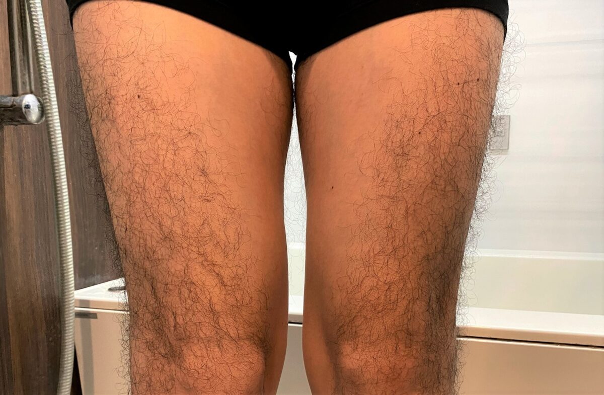 男の全身脱毛前のもも