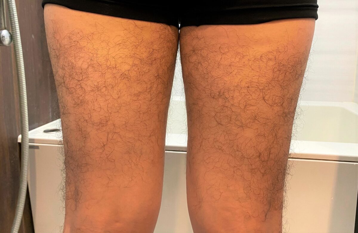 男の全身脱毛前のもも裏