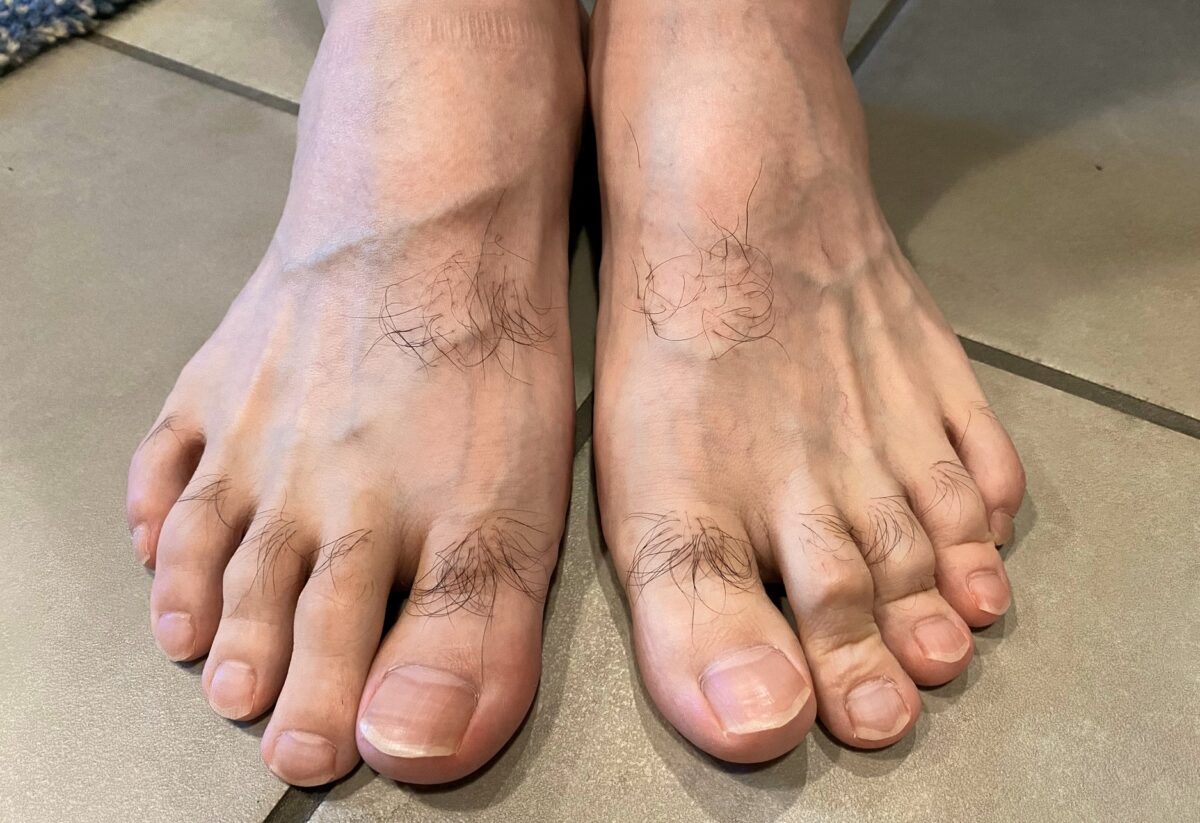 男の全身脱毛開始前