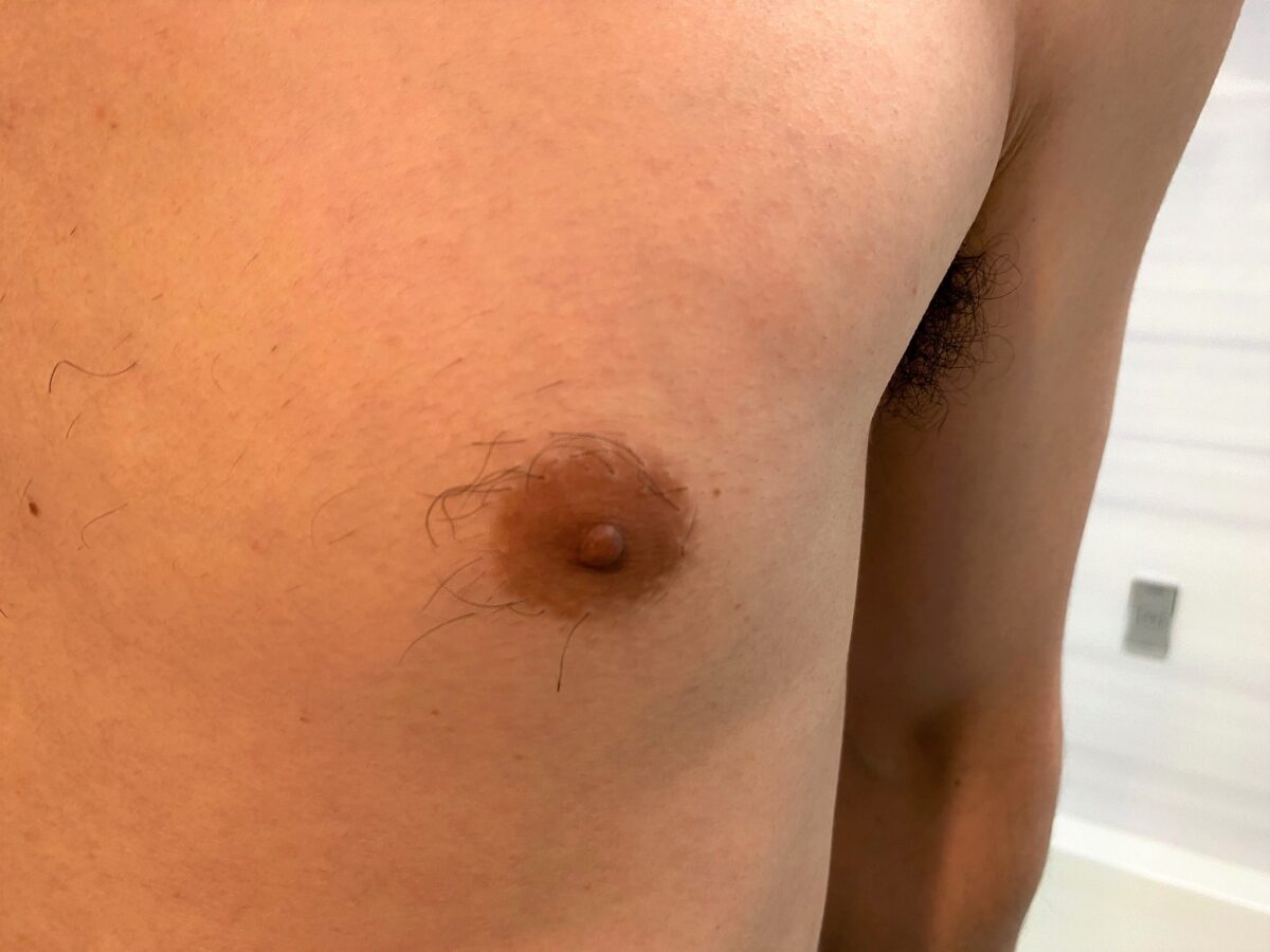 男の全身脱毛前の胸