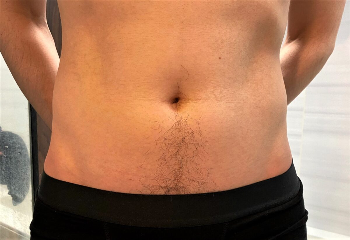 男の全身脱毛開始前