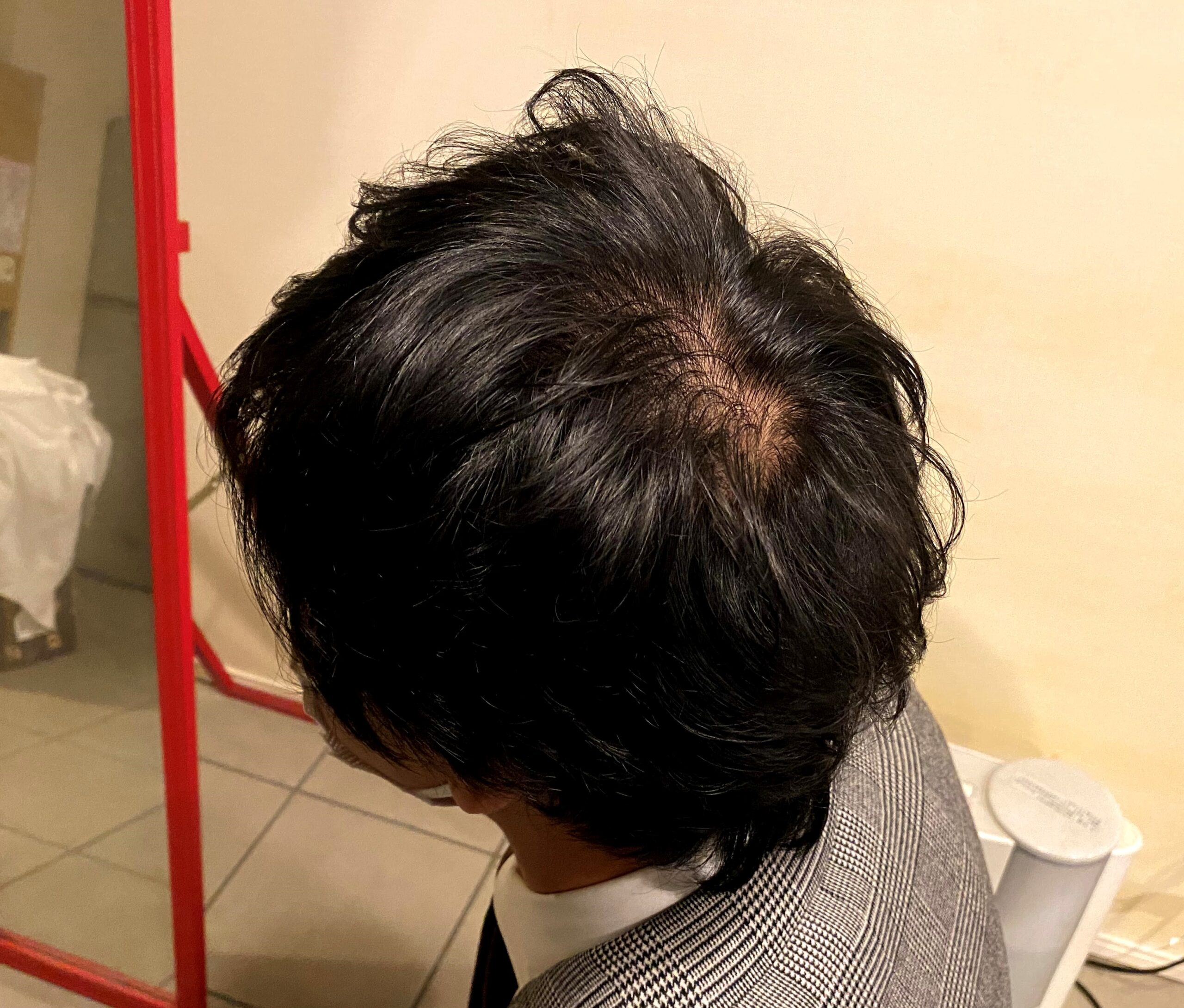 AGA治療1カ月後の30代男性