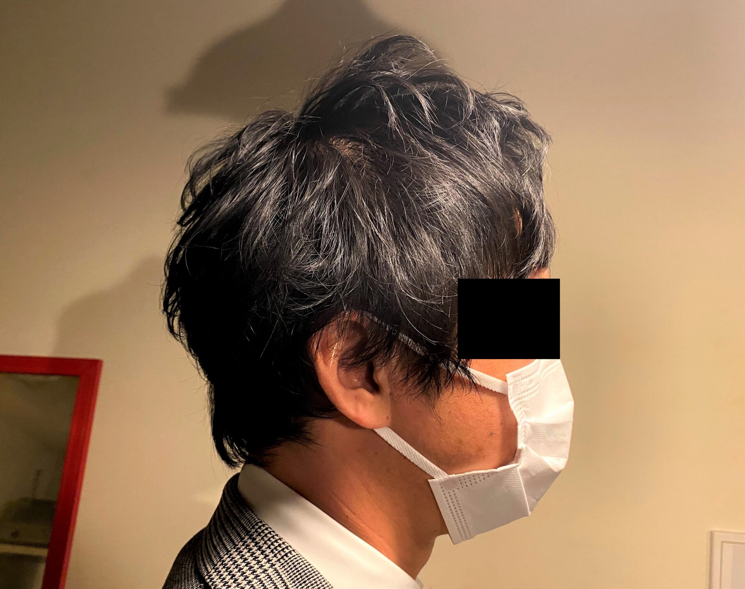 AGA治療1カ月後の30代男性