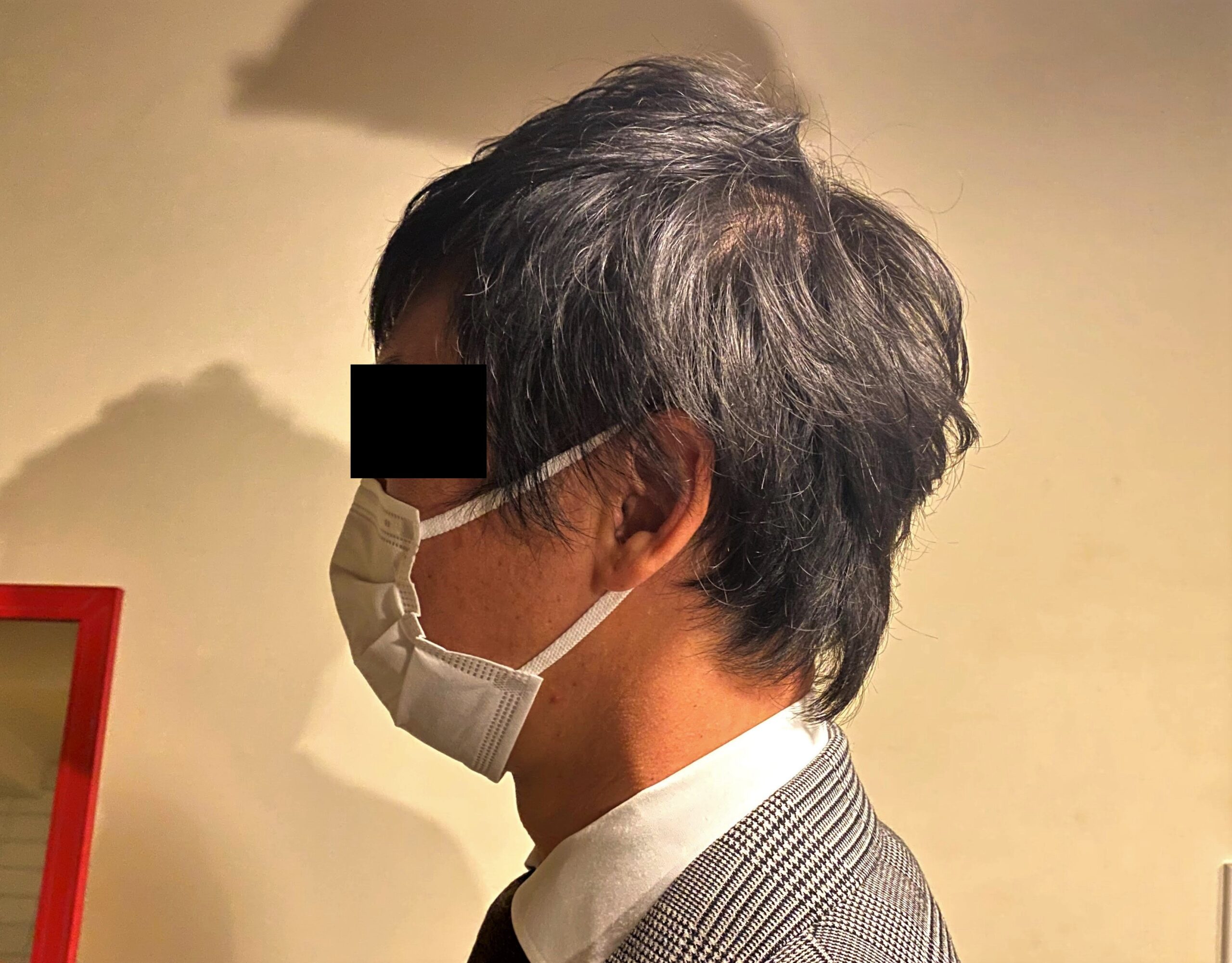 AGA治療1カ月後の30代男性