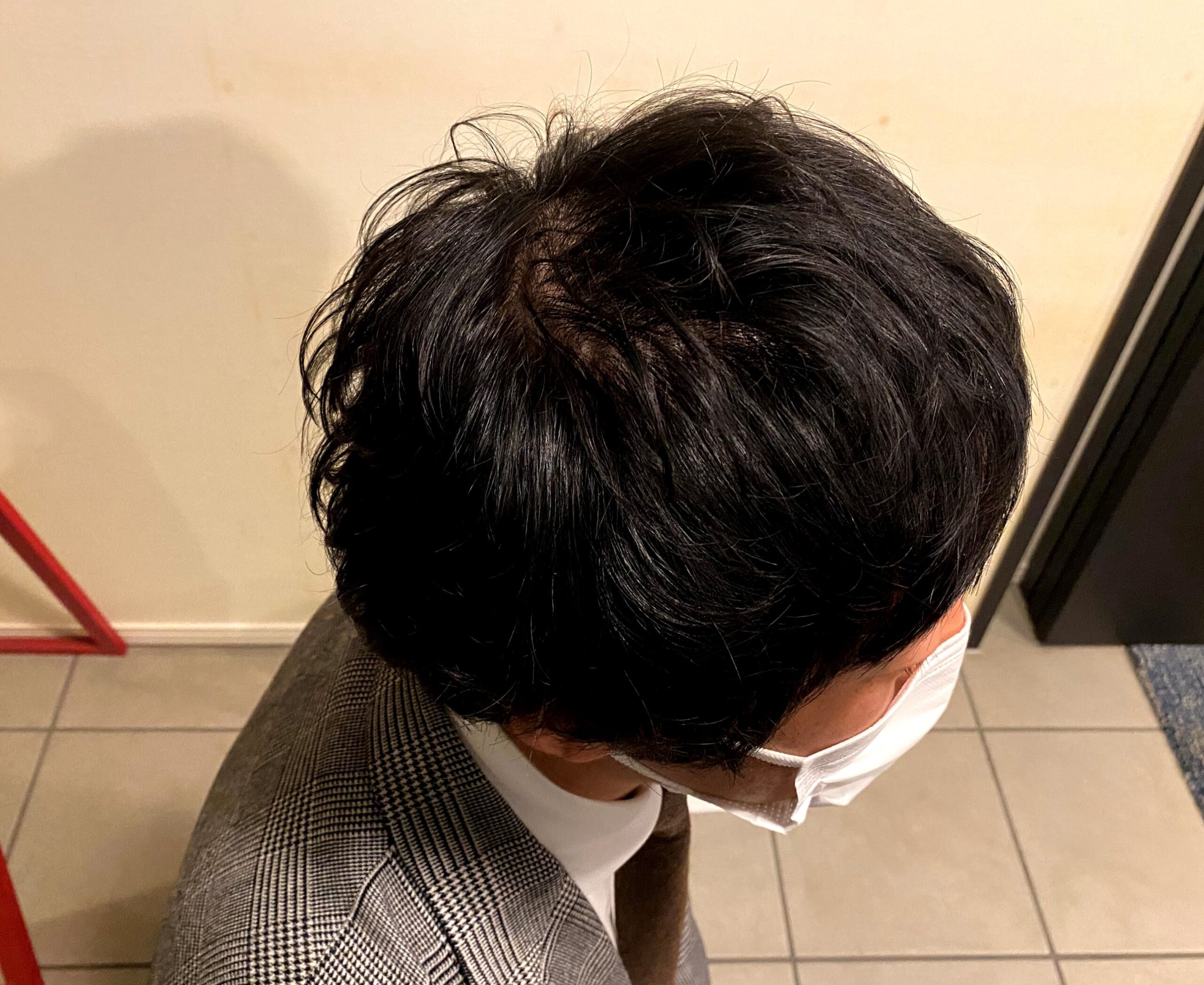 AGA治療1カ月後の30代男性