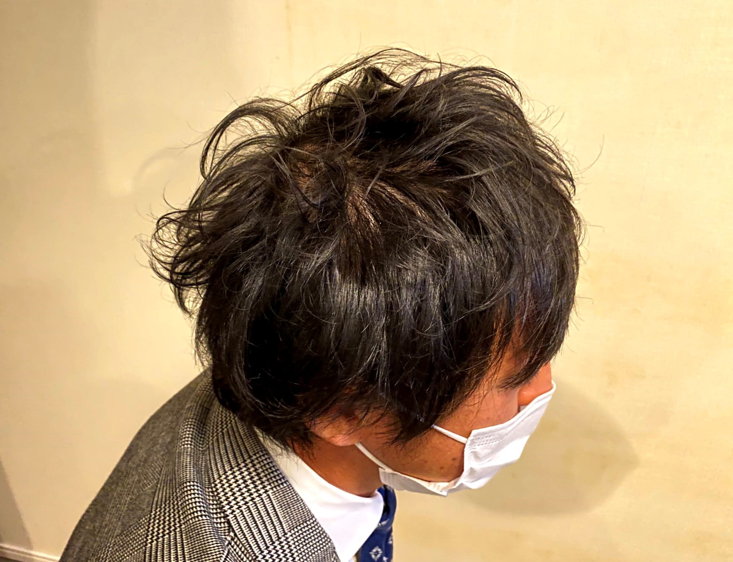 AGA治療前の30代男性