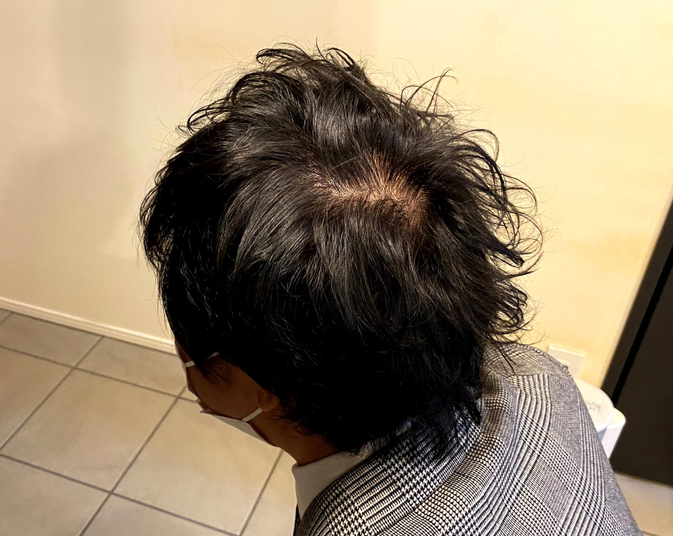 AGA治療前の30代男性
