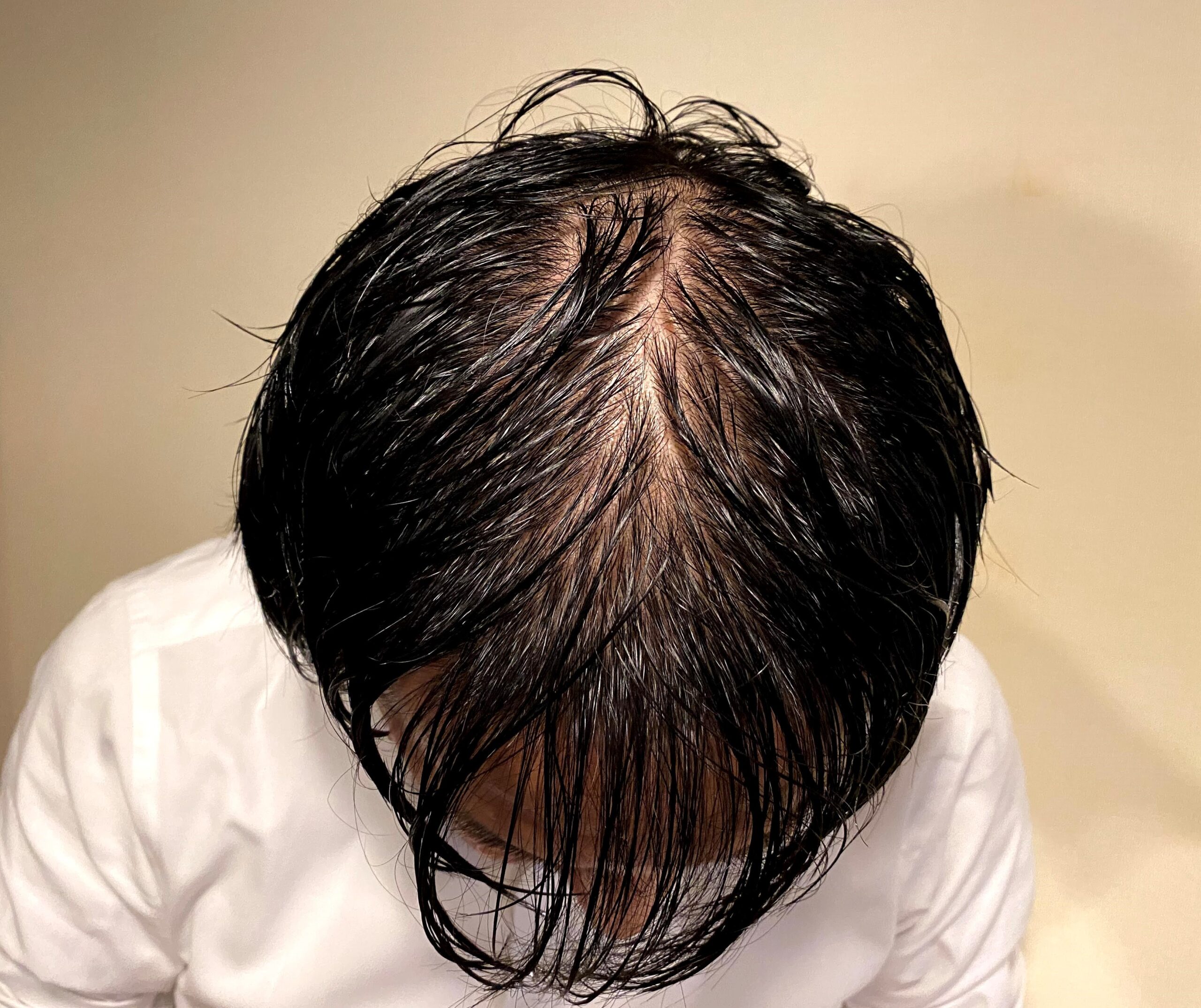AGA治療前の30代男性