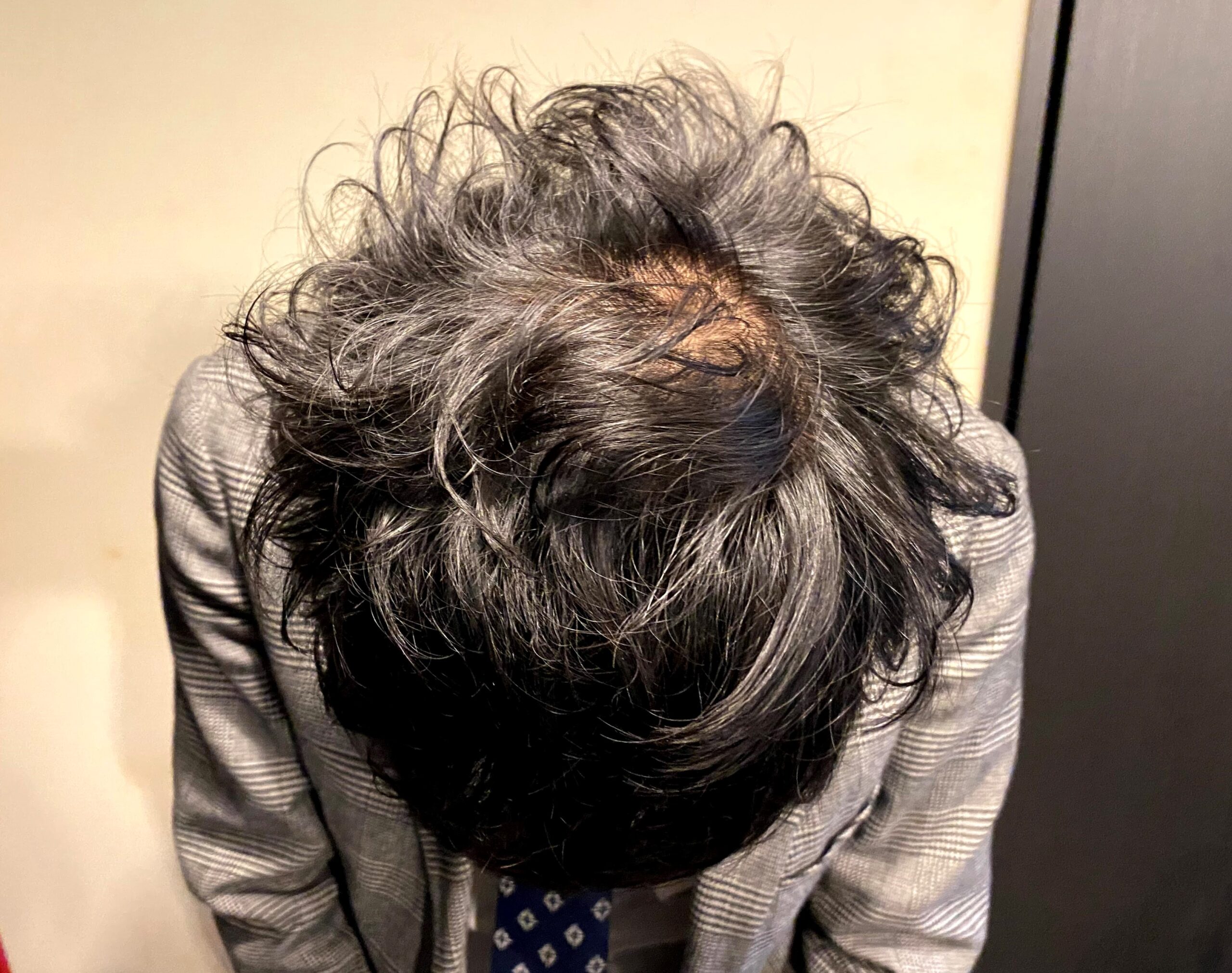 AGA治療前の30代男性