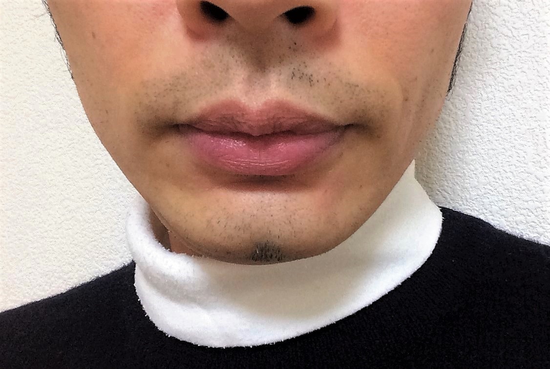 ヒゲ脱毛でツルツルになるまで