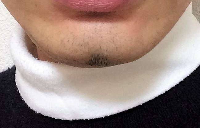 ヒゲ脱毛でツルツルになるまで