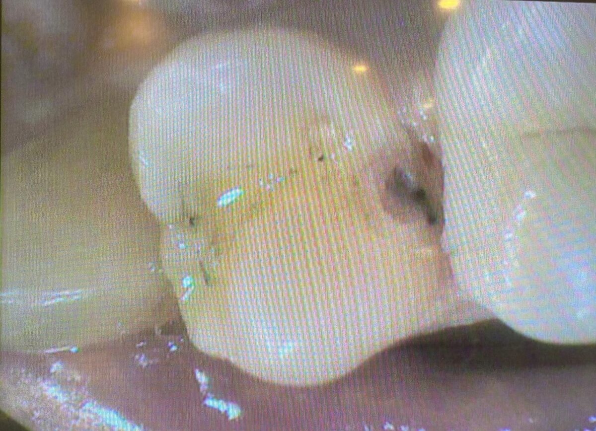 詰め物の下にできた虫歯