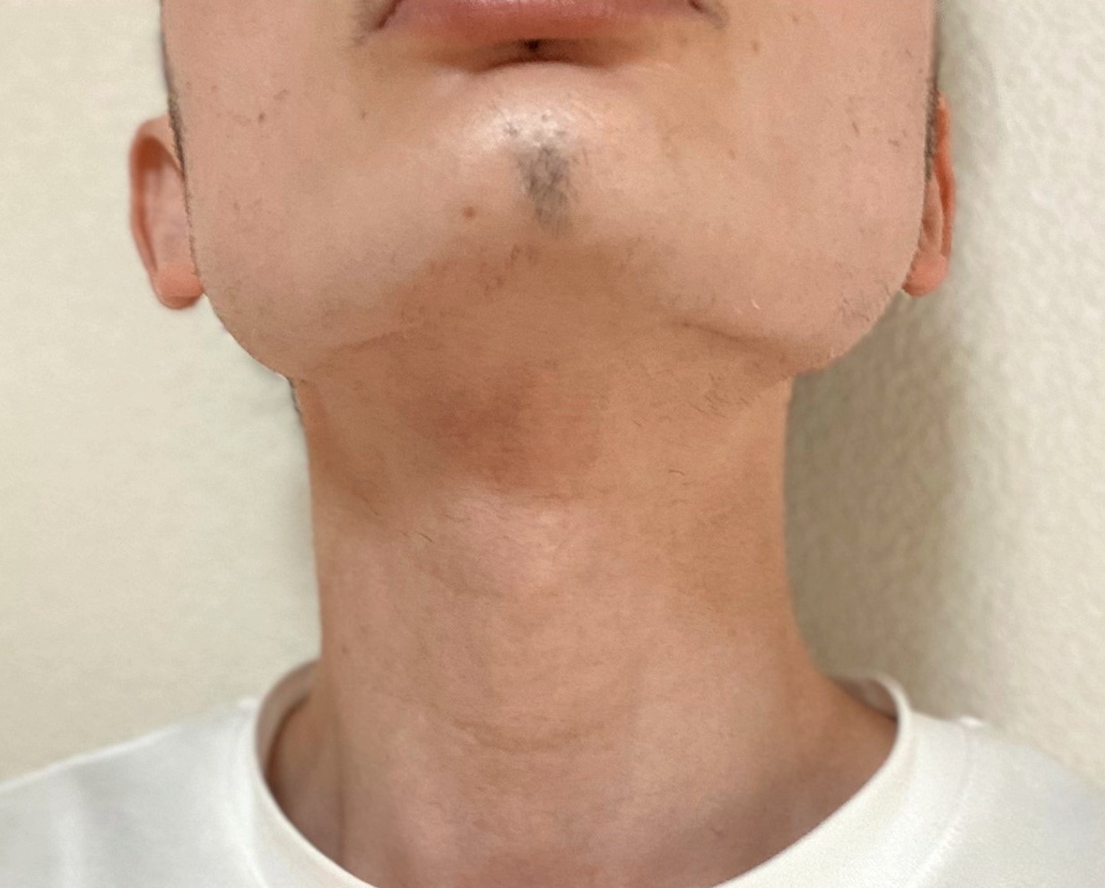 ヒゲ脱毛19回目の効果