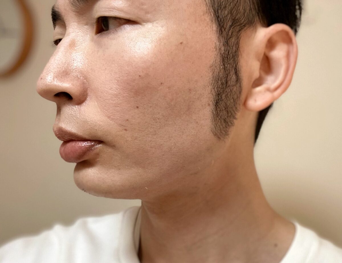 頬ヒゲ脱毛9回目の施術の効果