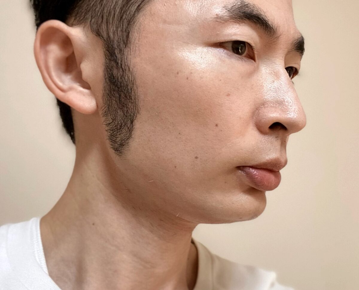 頬ヒゲ脱毛9回目の施術の効果