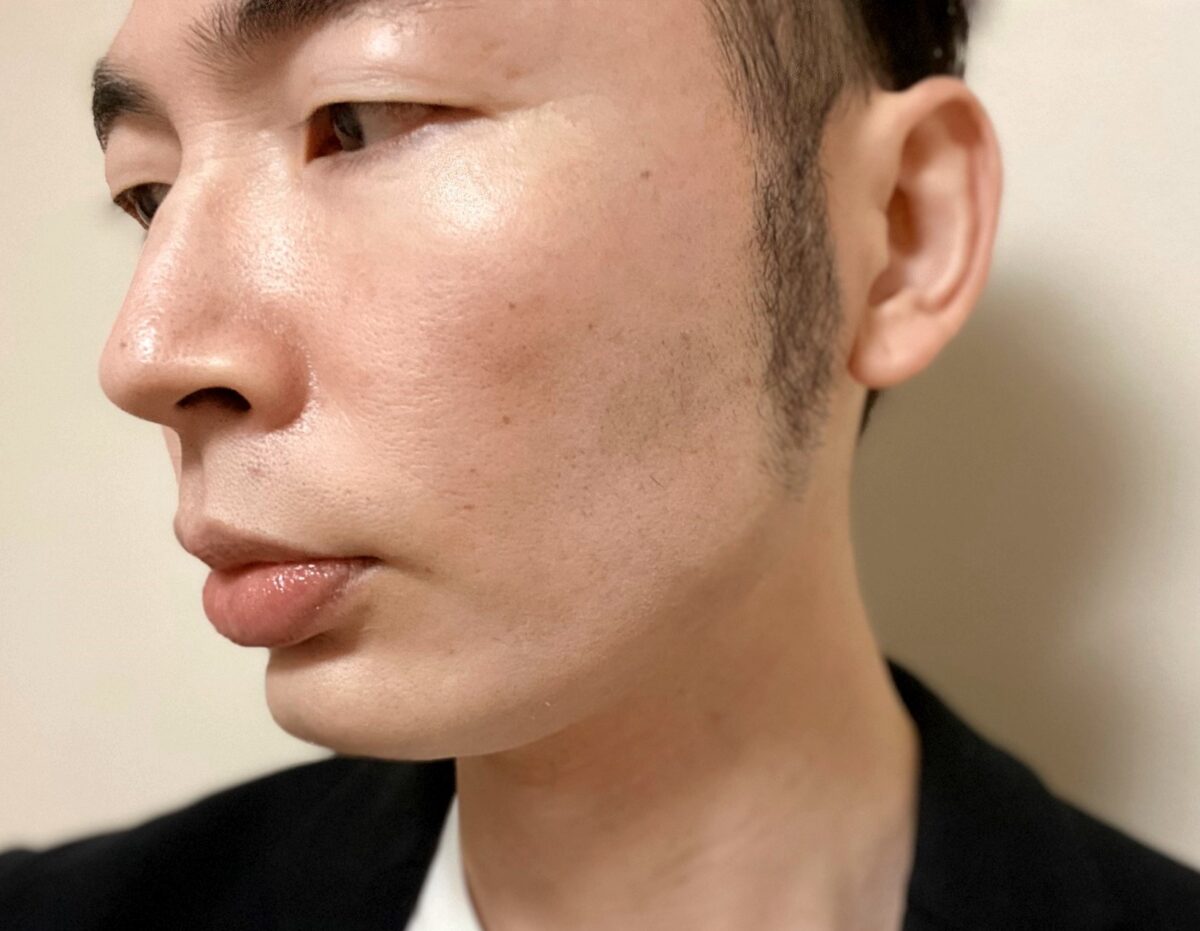 頬ヒゲ脱毛9回目の施術の効果