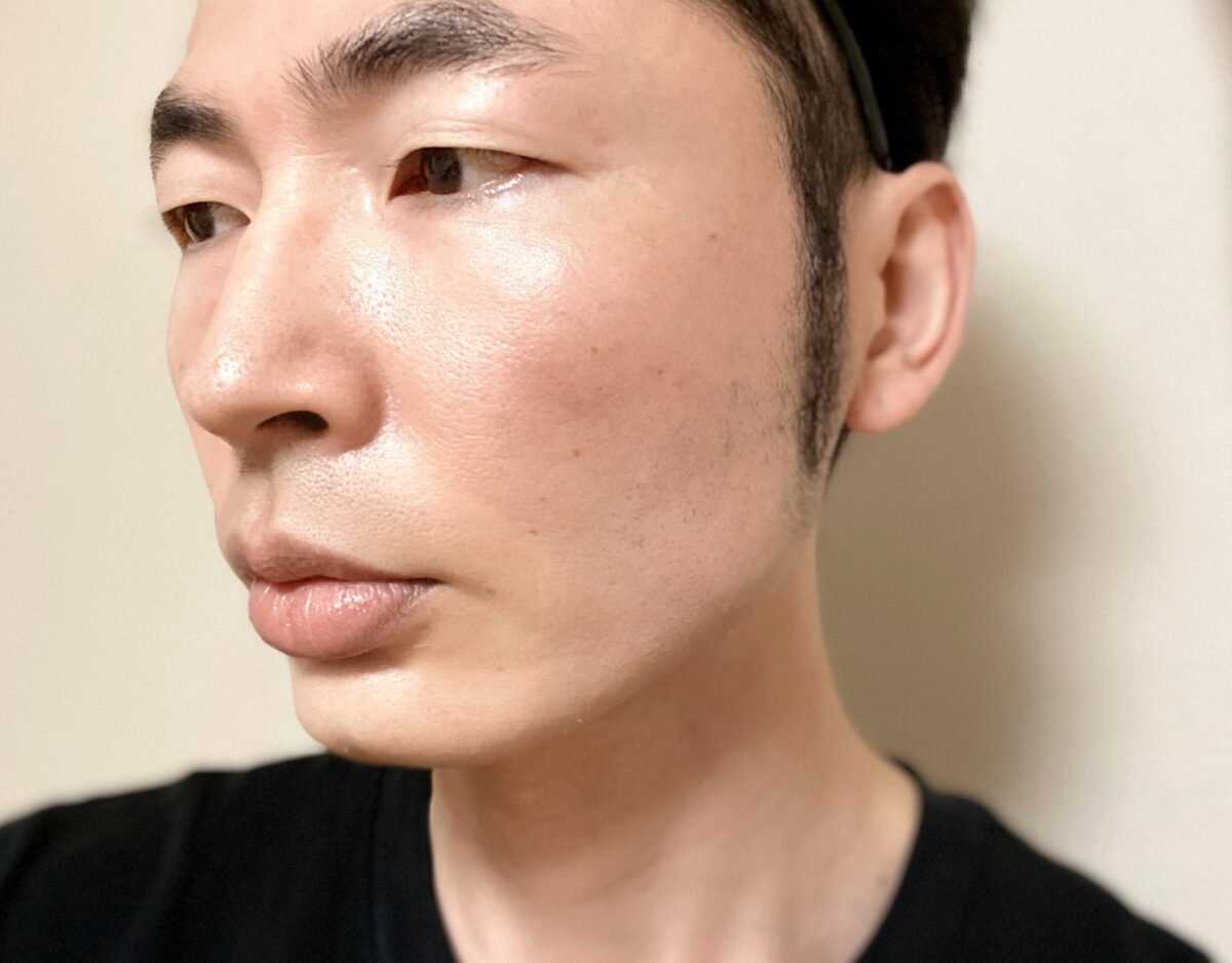 頬ヒゲ脱毛9回目の施術の効果