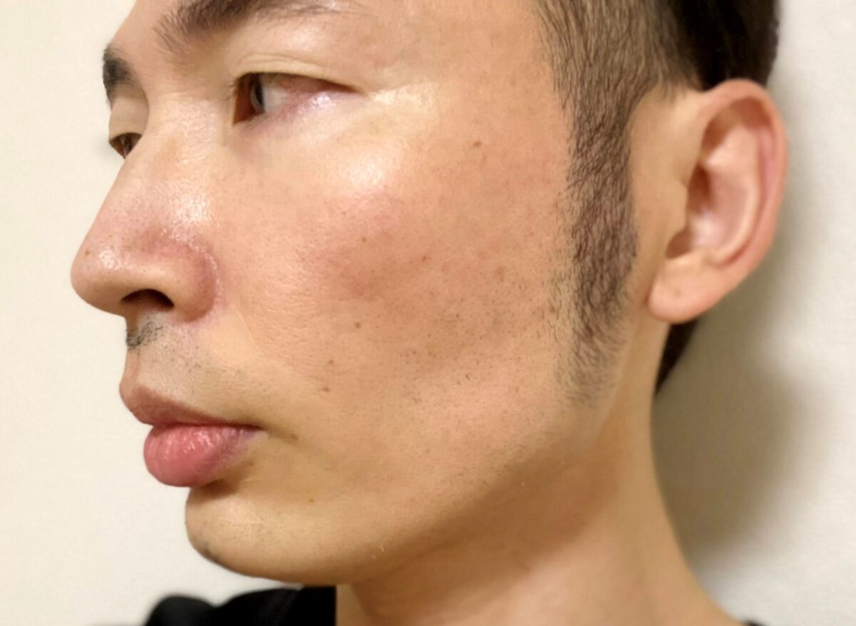 頬ヒゲ脱毛9回目の効果
