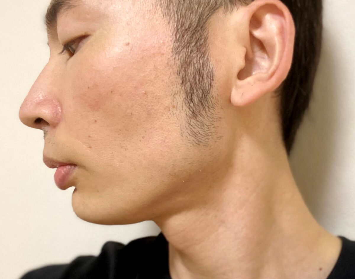 頬ヒゲ脱毛9回目の効果