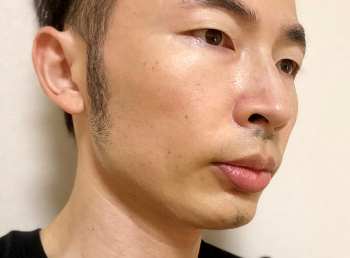 頬ヒゲ脱毛9回目の効果