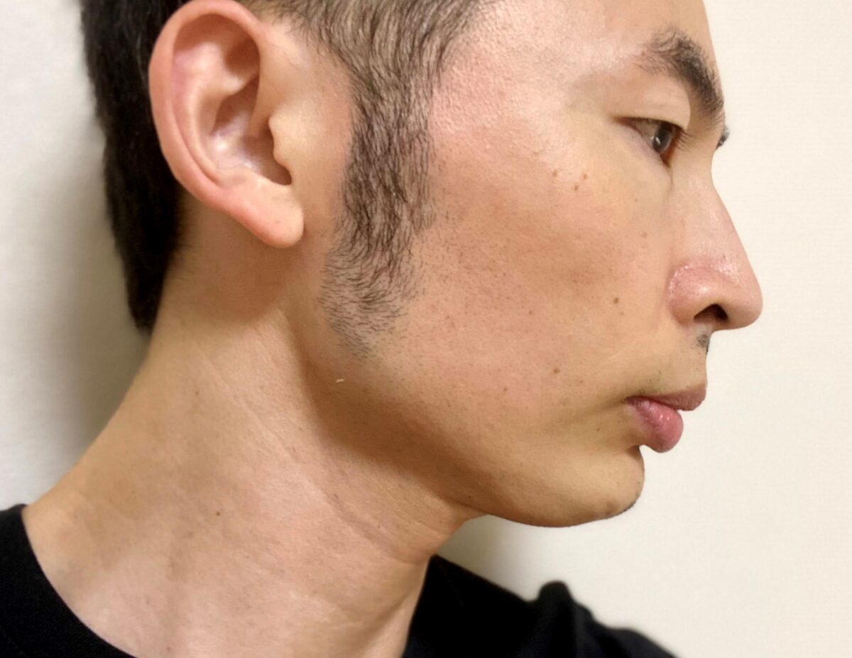 頬ヒゲ脱毛9回目の効果