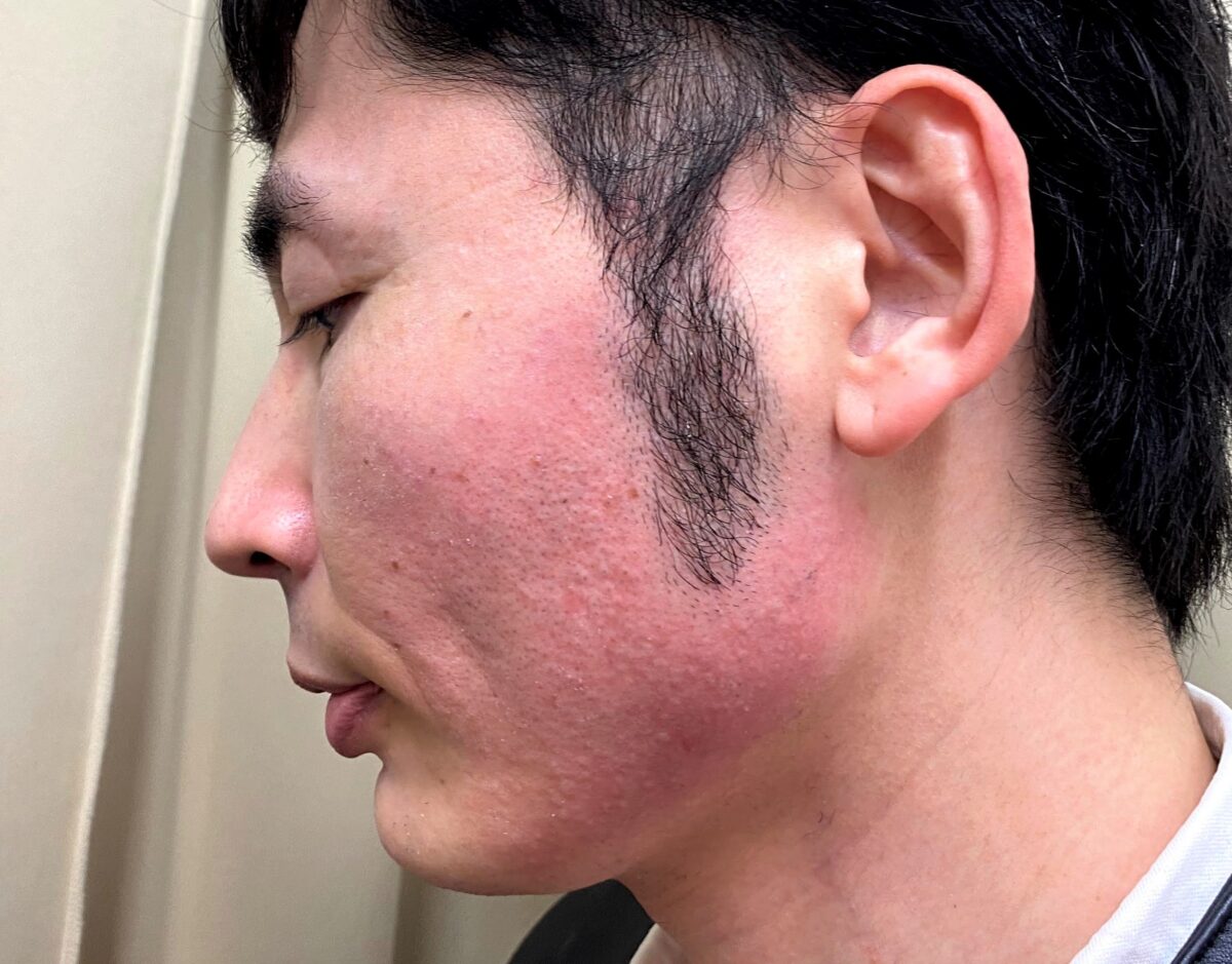 湘南美容クリニックで頬ヒゲ脱毛の施術を受けた後