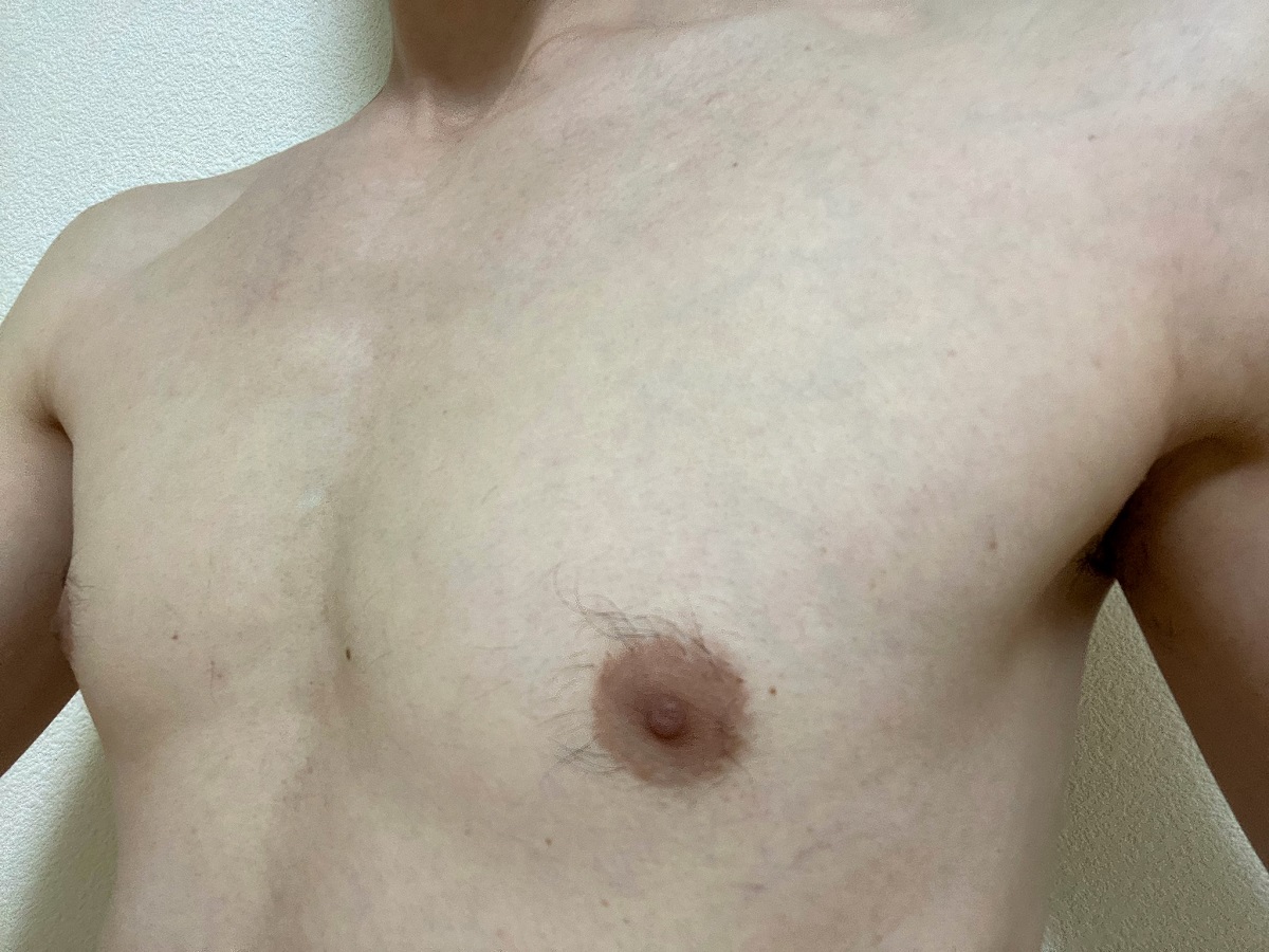 全身脱毛2回目の効果3カ月後