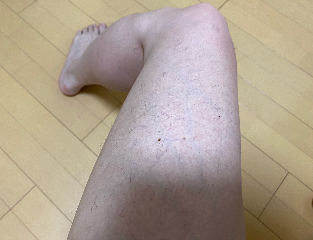 男の全身脱毛2回目の結果