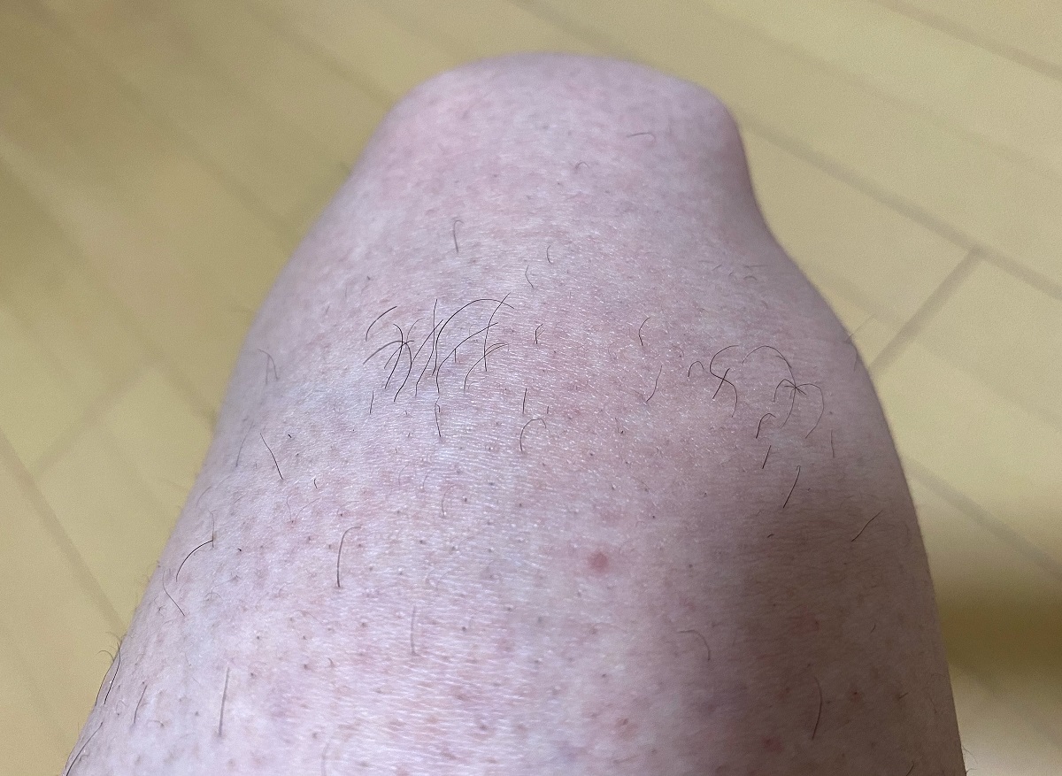 男の全身脱毛前2回目の効果