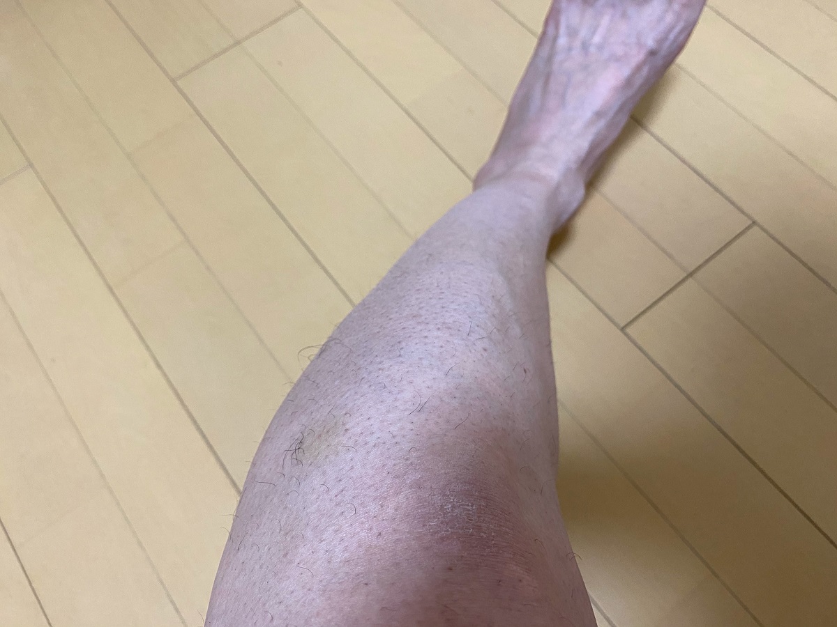 全身脱毛2回目の効果