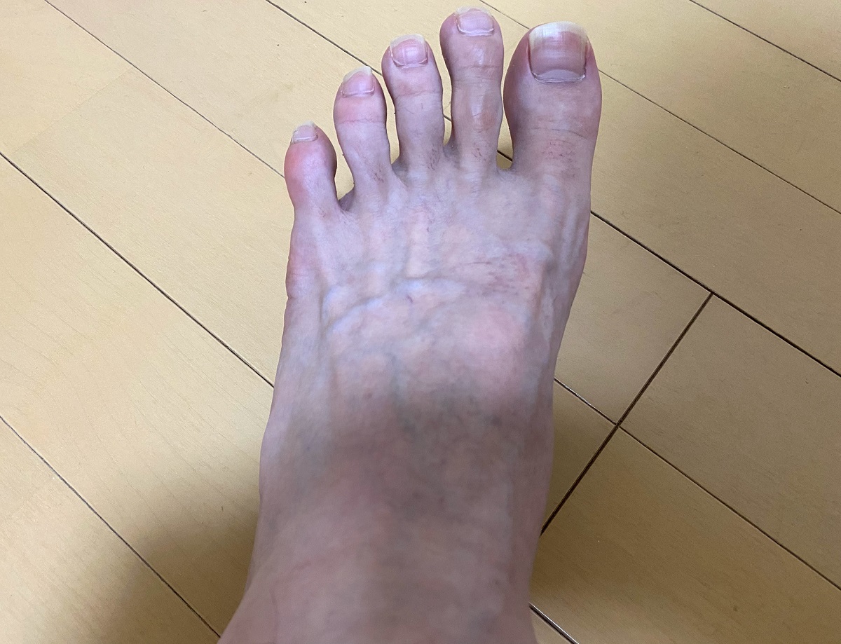 全身脱毛2回目の効果