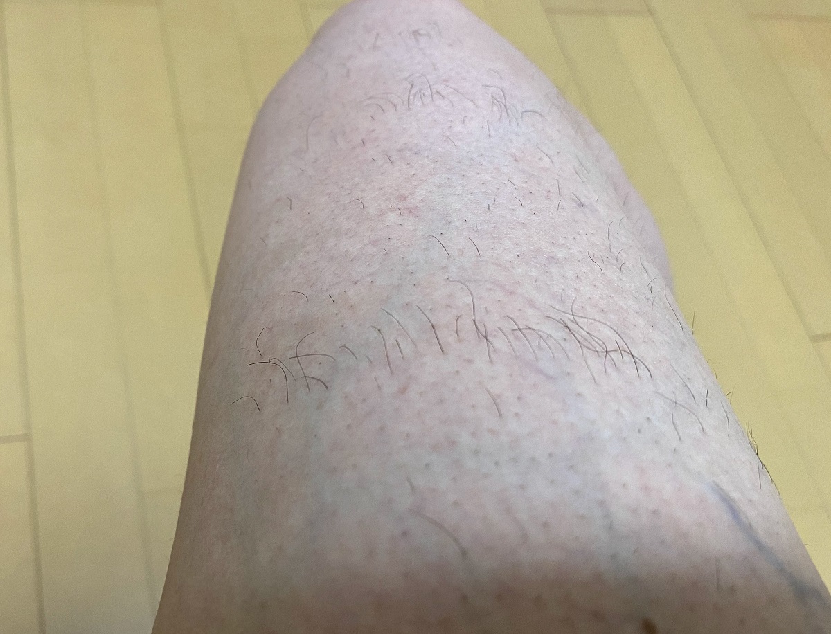 全身脱毛2回目の効果