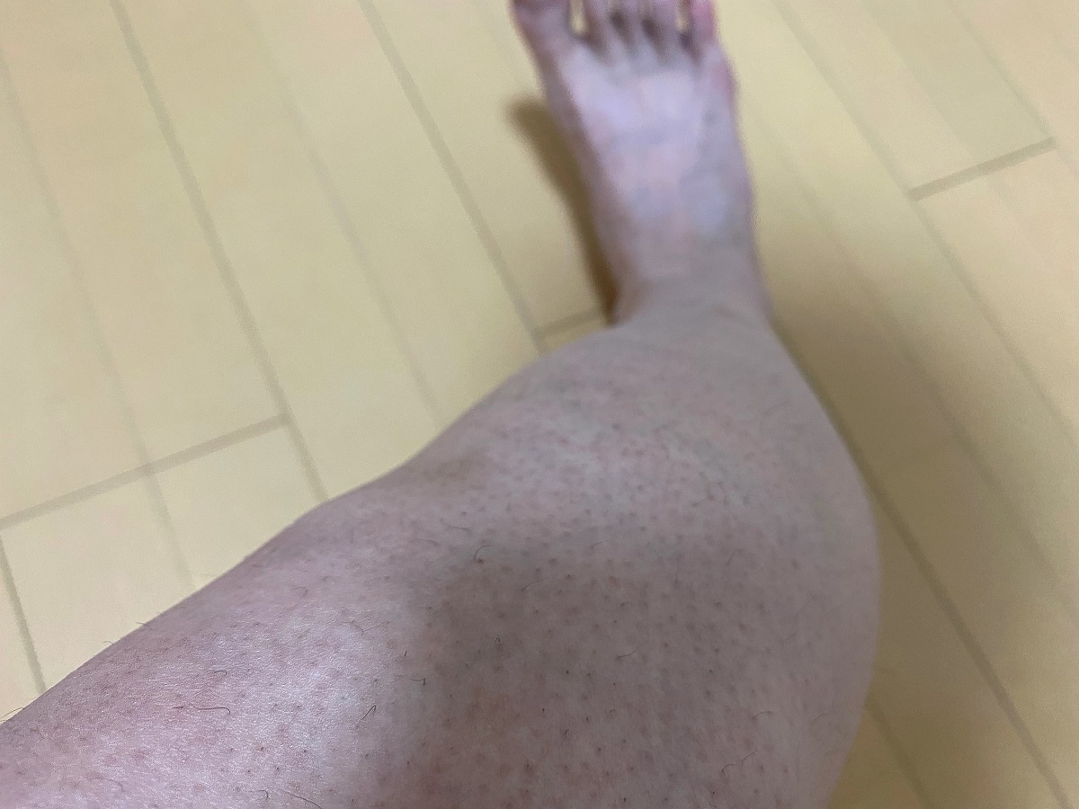 全身脱毛2回目の効果