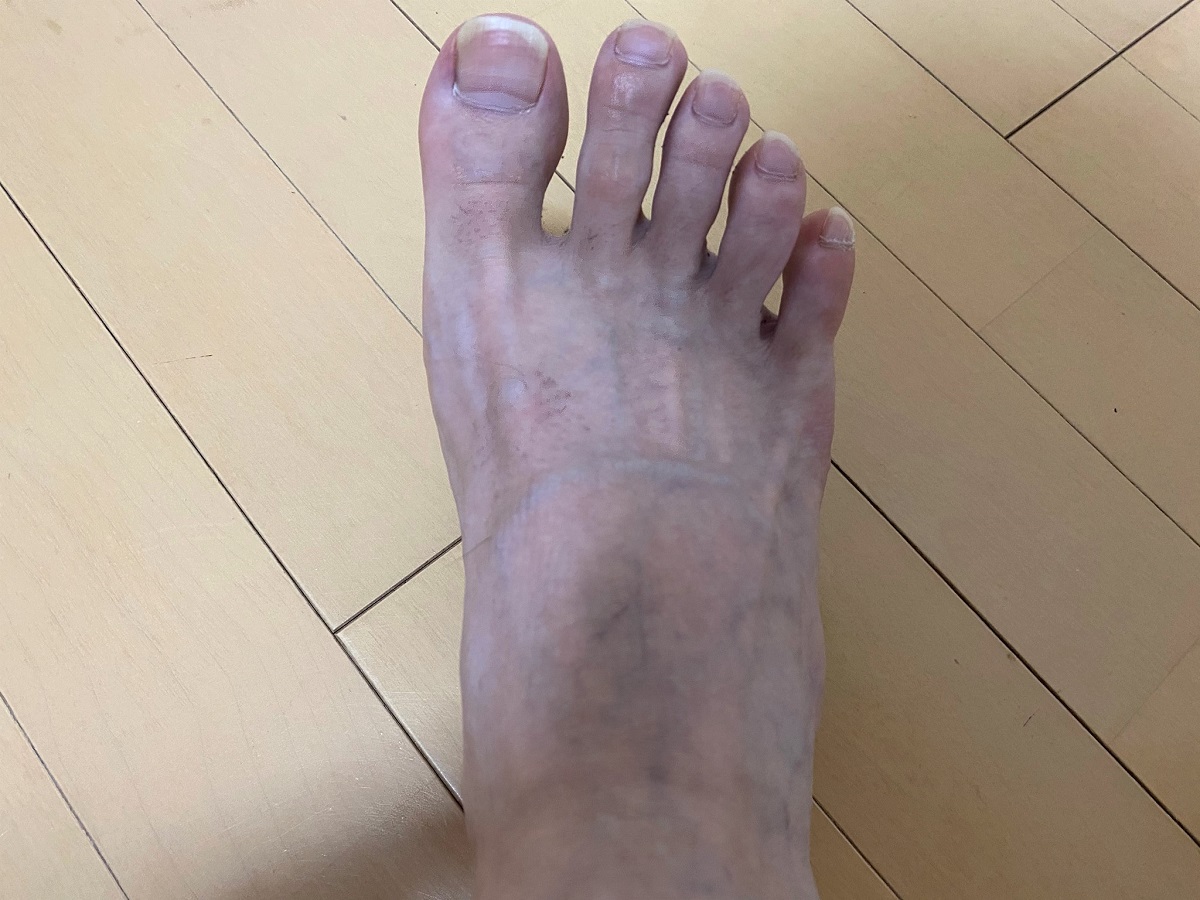 全身脱毛2回目の効果