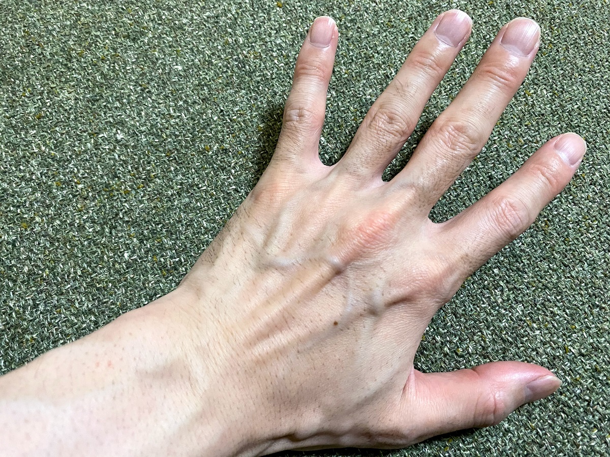 全身脱毛2回目の効果2カ月後
