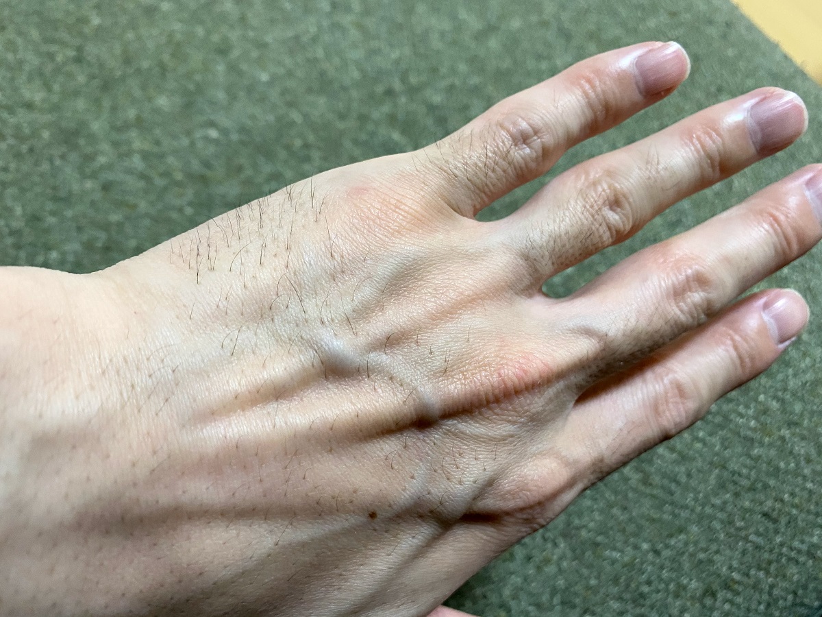 全身脱毛2回目の効果2カ月後