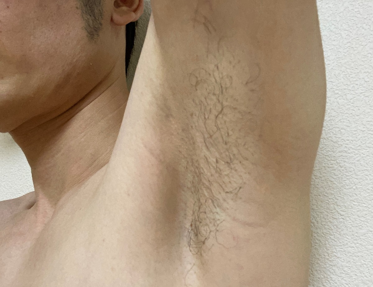 全身脱毛2回目の効果3カ月後