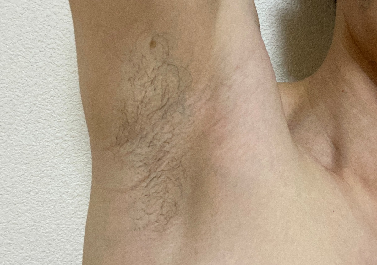 全身脱毛2回目の効果3カ月後