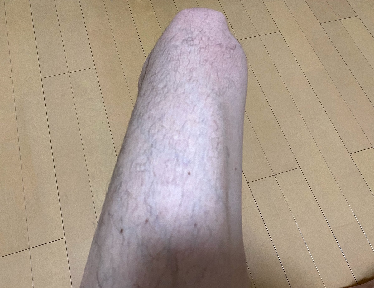 全身脱毛2回目の効果4カ月後