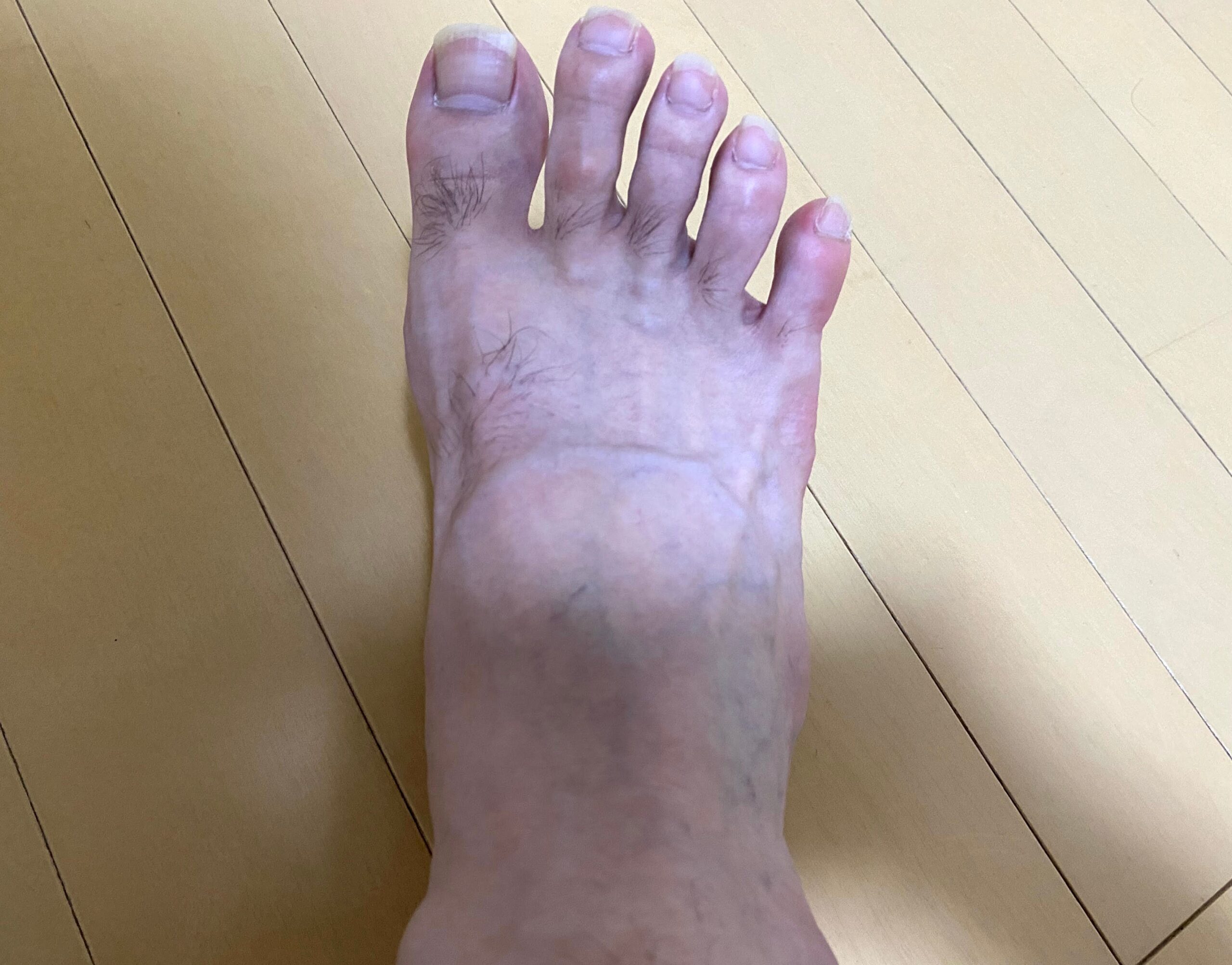 全身脱毛2回目の効果4カ月後