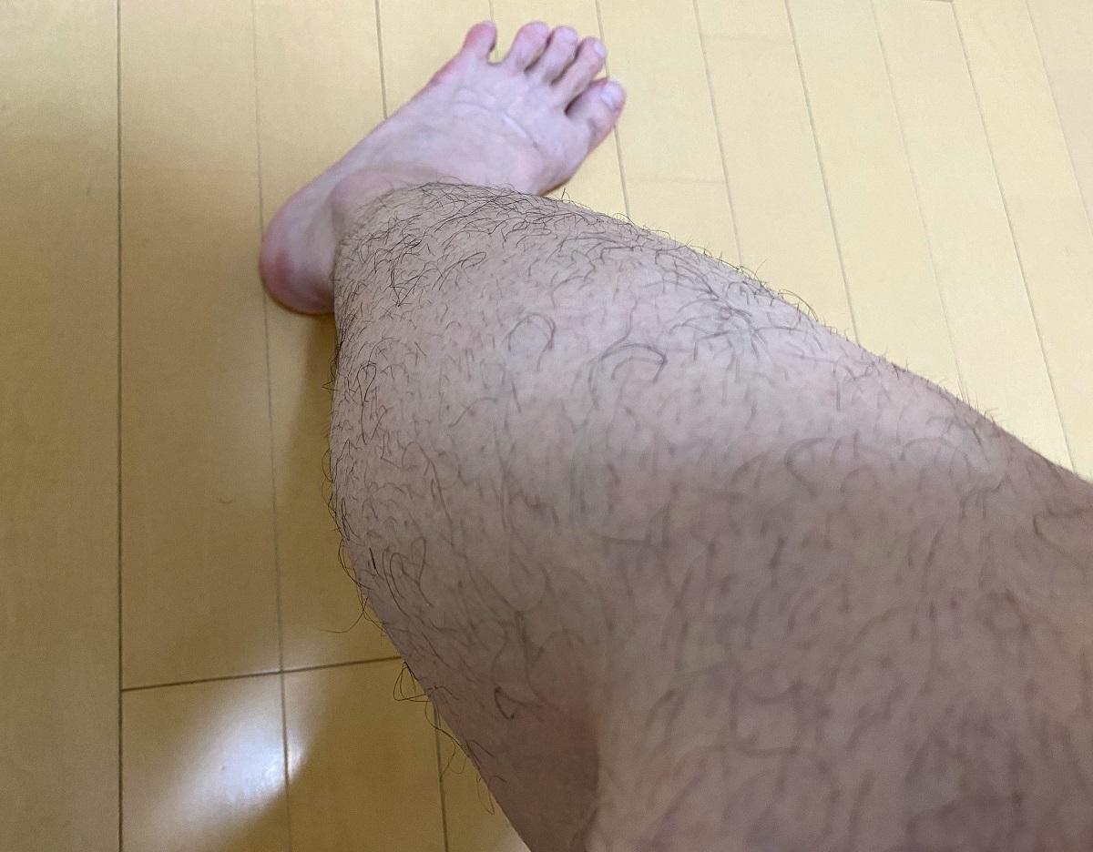 全身脱毛2回目の効果4カ月後